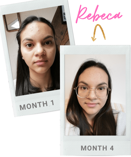 Rebeca acne progress photos - the acne clinic